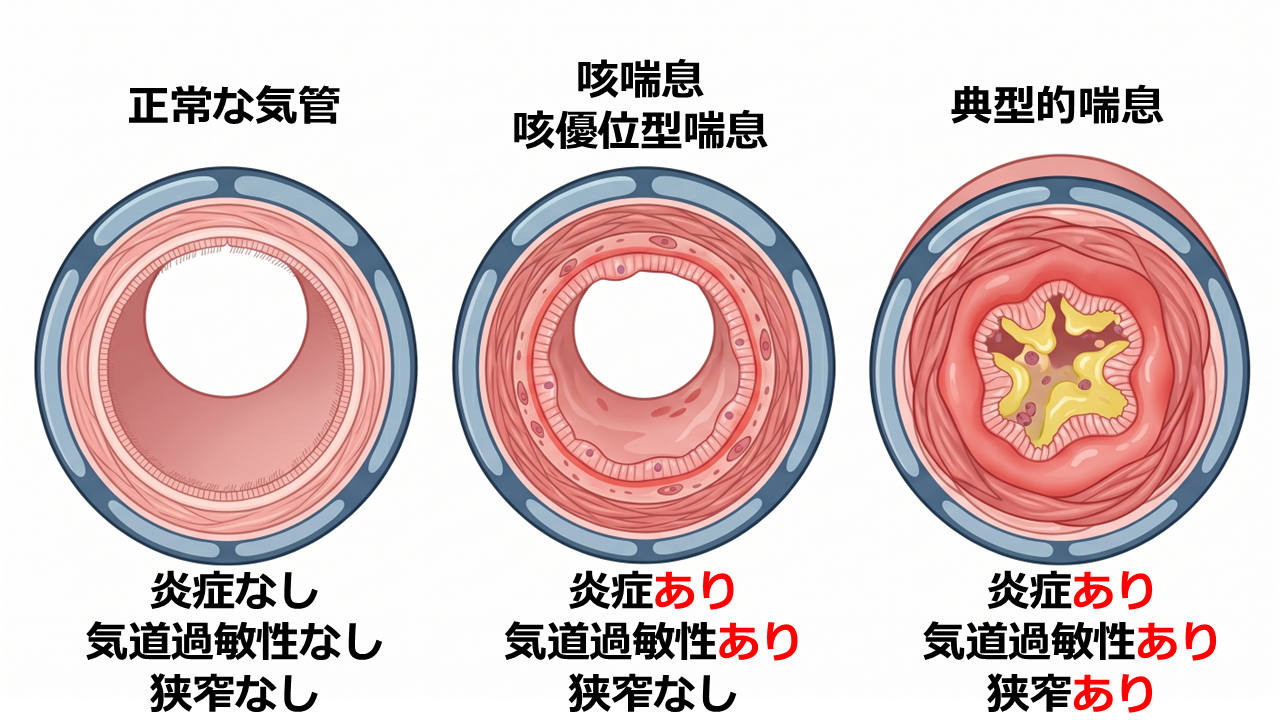 気道の変化（正常な気道と炎症で狭くなった気道の比較）